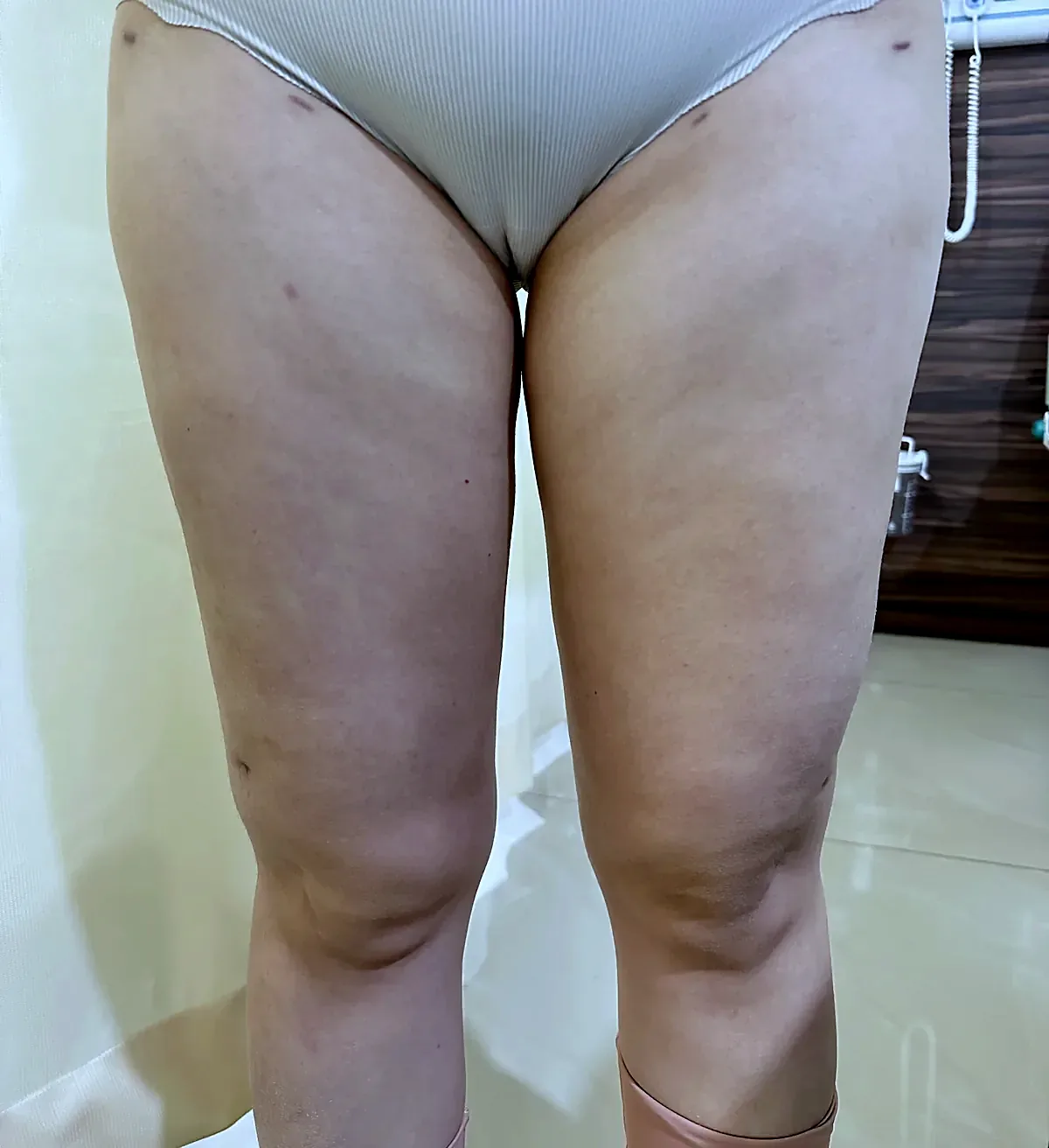 After surgery