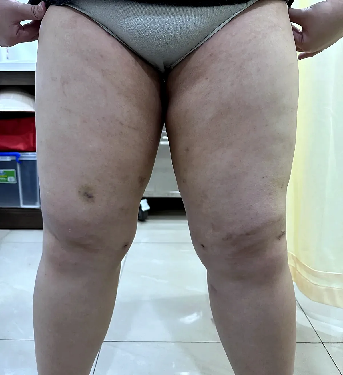 After surgery