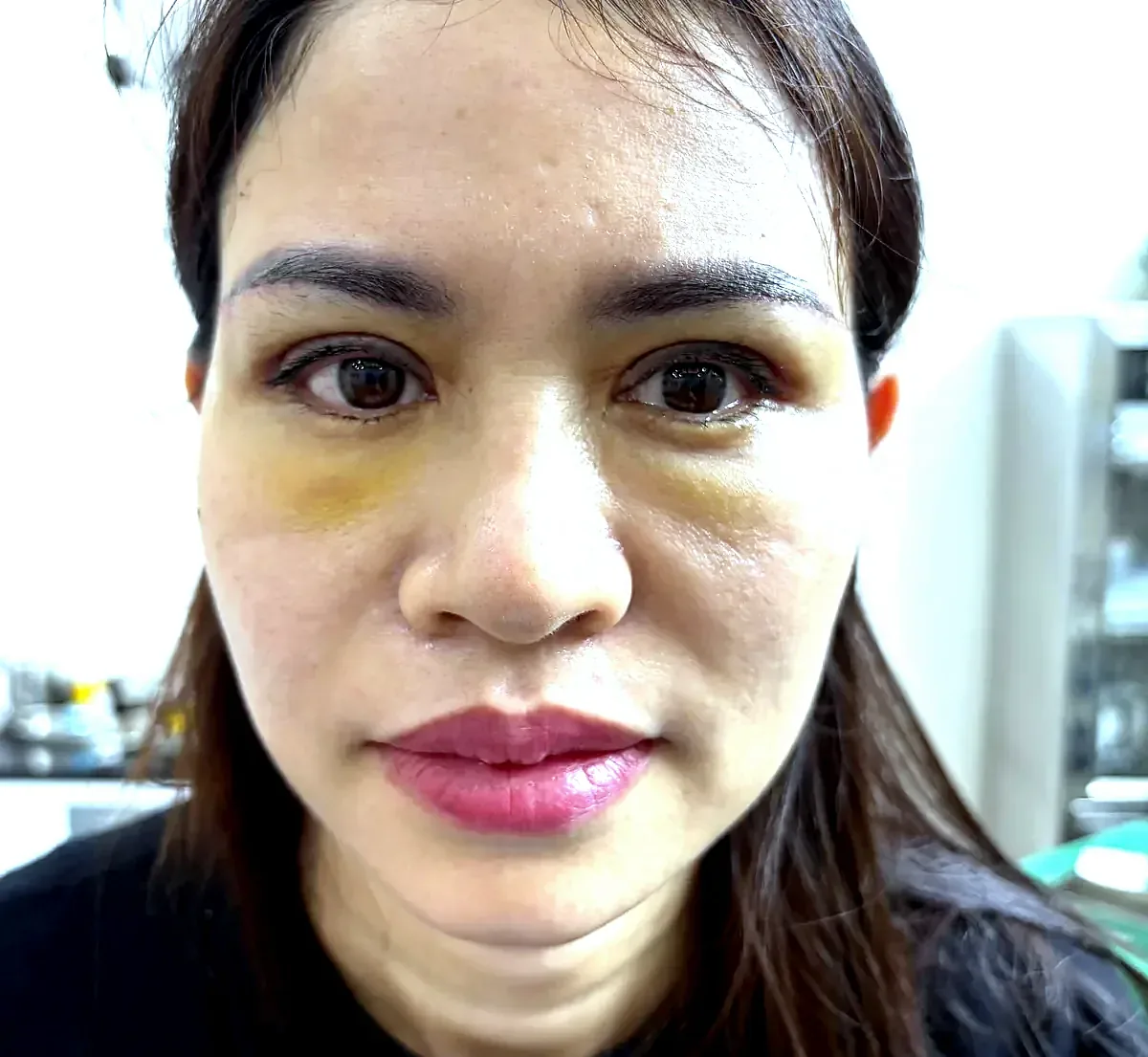 After surgery