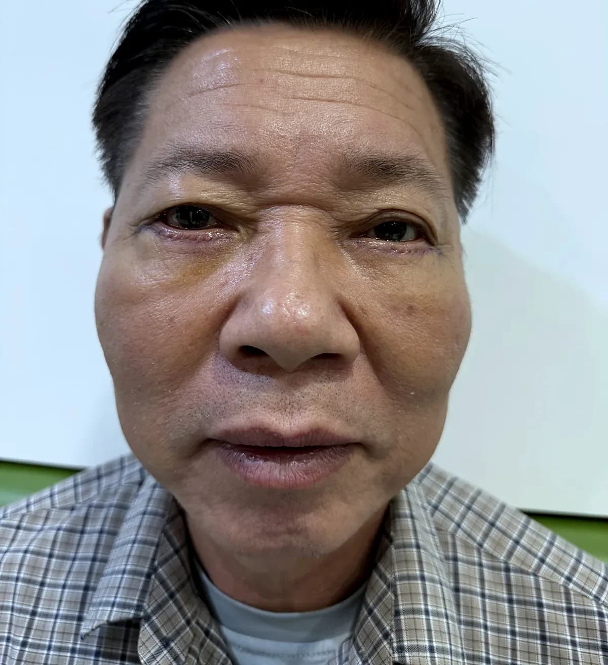 After surgery