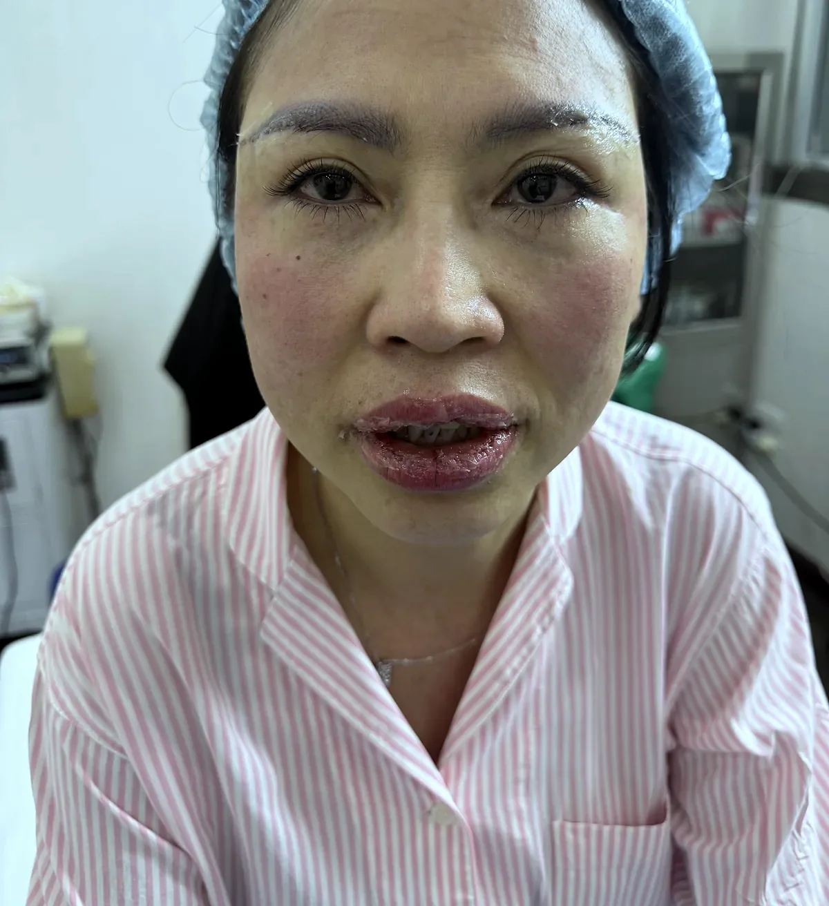 After surgery