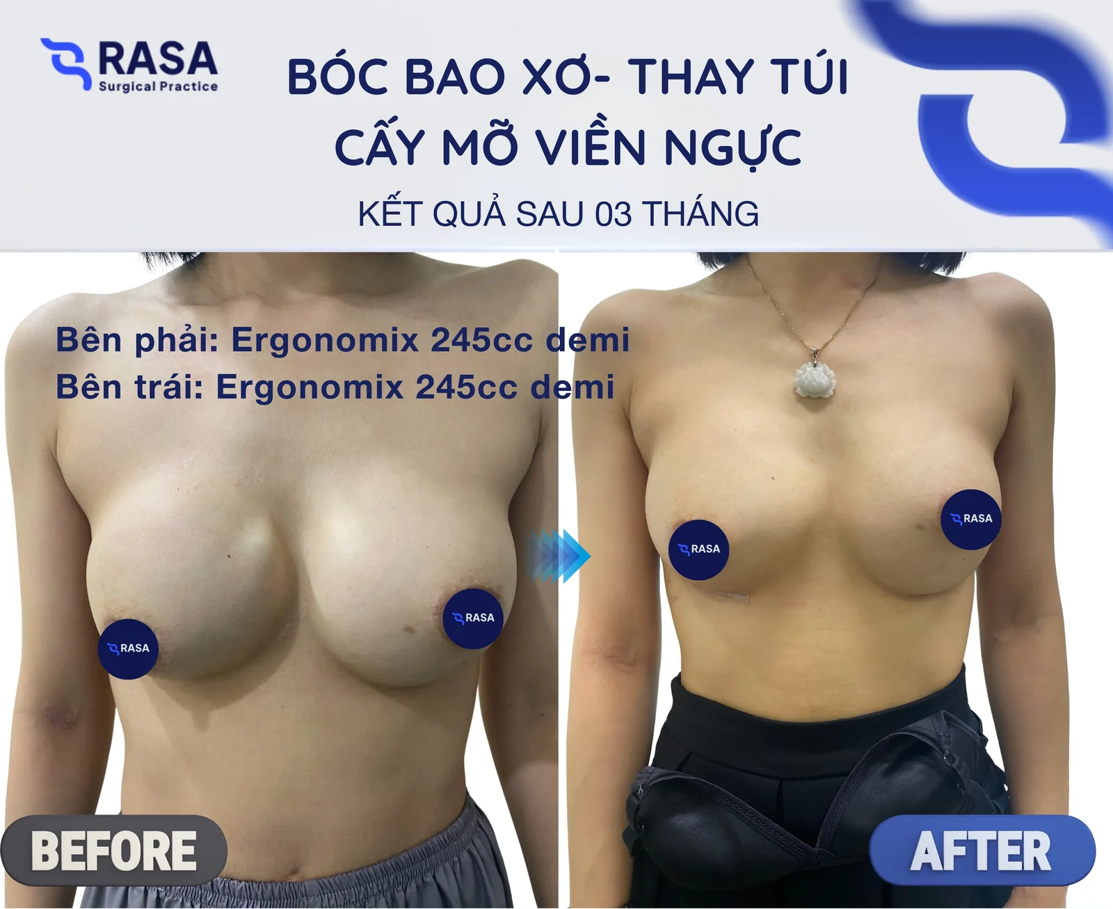 Bóc bao xơ - thay túi + cấy mỡ viền - Sau 3 tháng