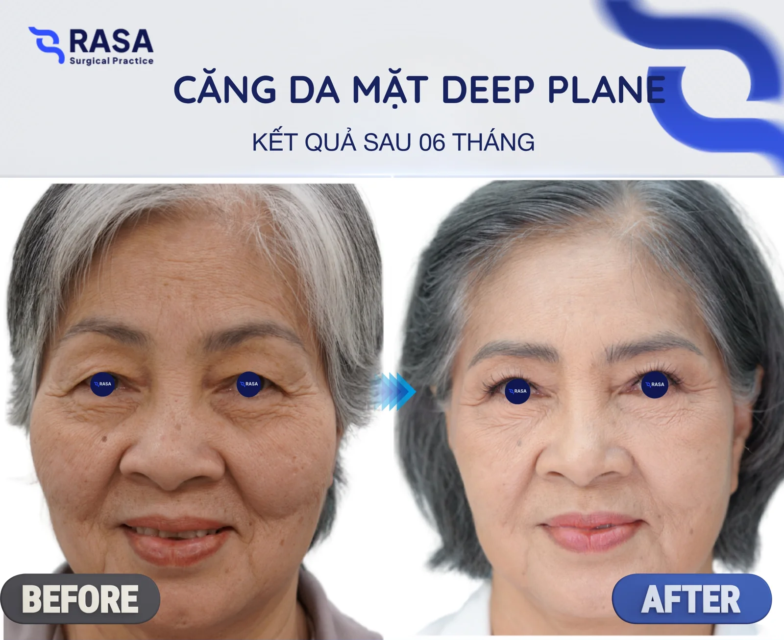Deep plane facelift - After 6 months