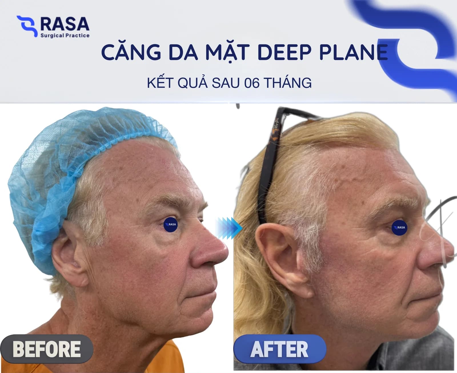 Deep plane facelift - After 6 months