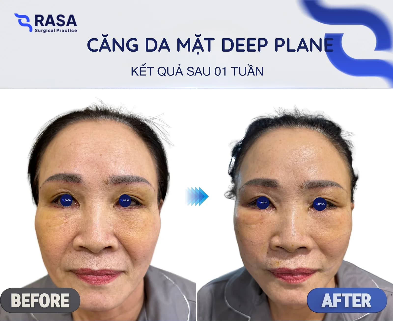 Căng da mặt Deep Plane - Sau 1 tuần