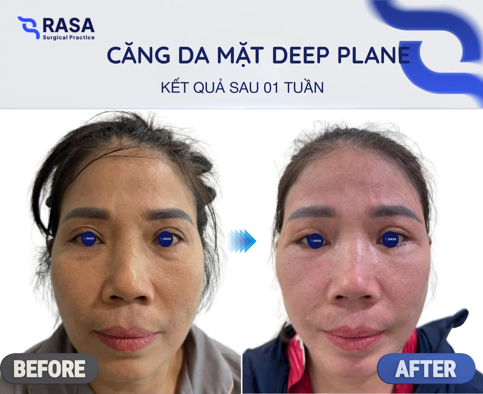 Deep plane facelift - After 1 week