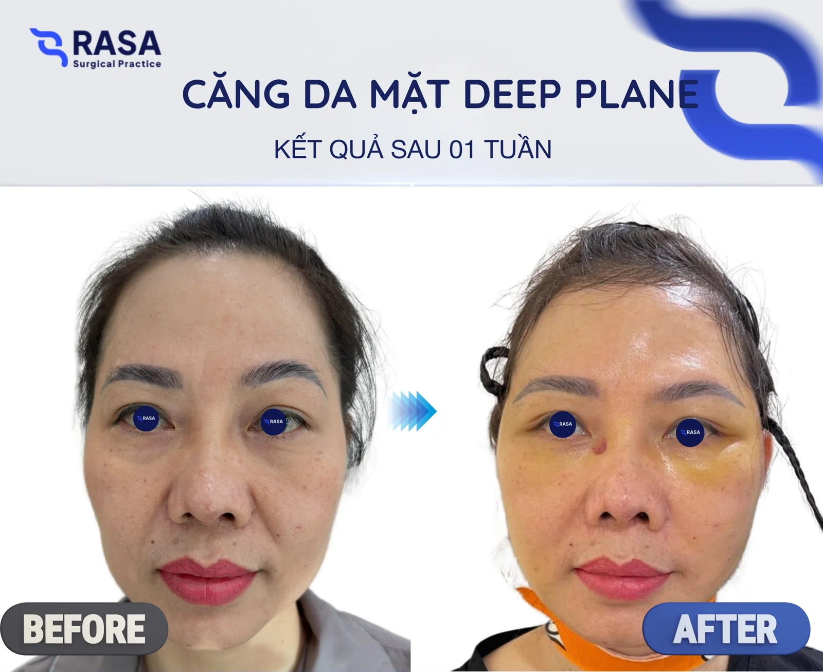 Deep plane facelift - After 1 week