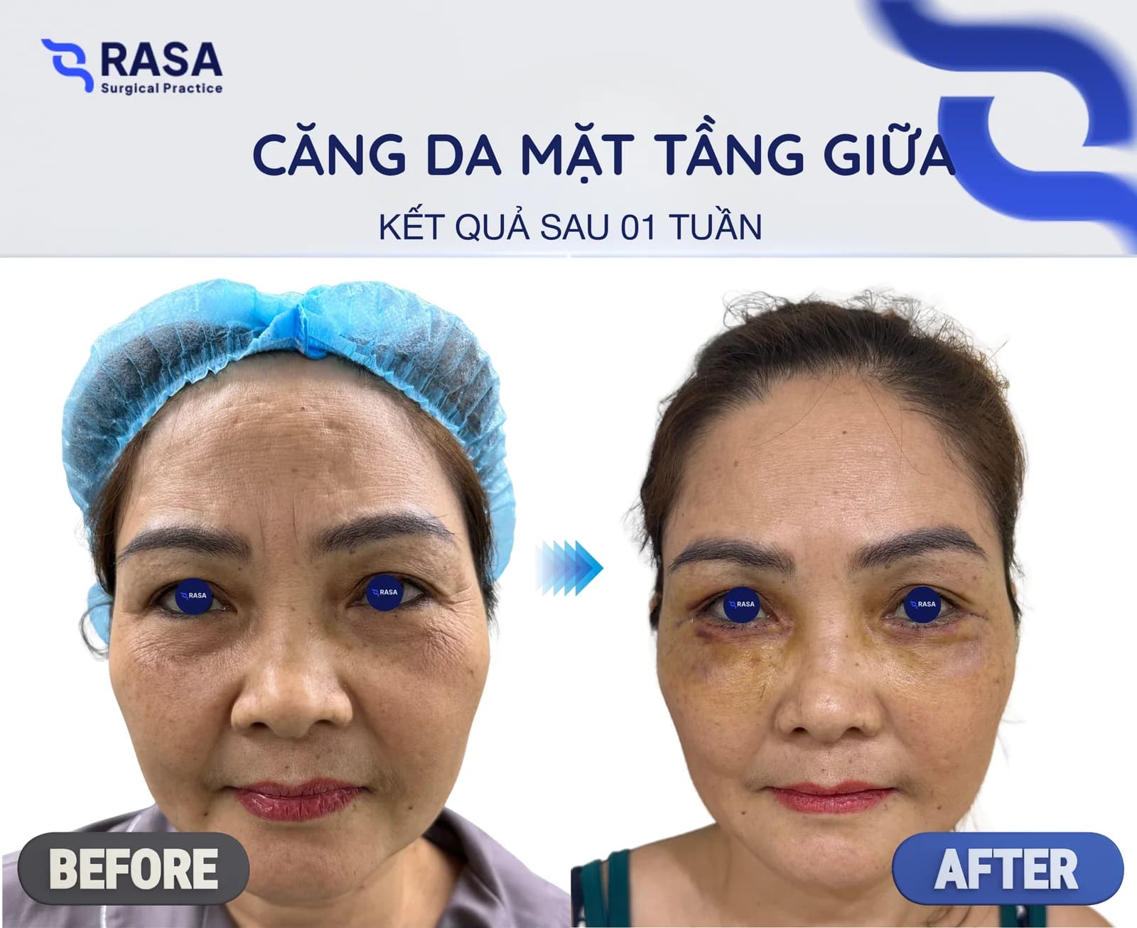 Midface lift - After 1 week