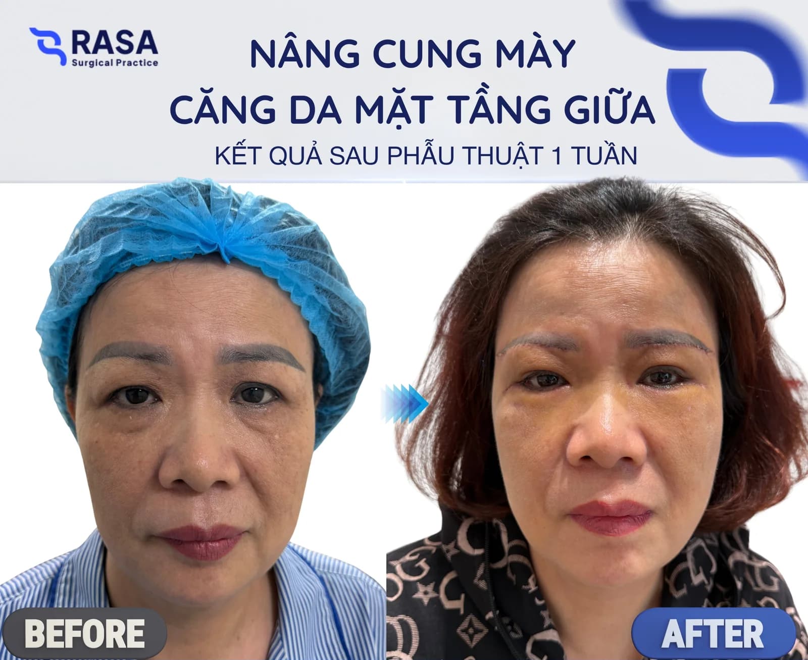 Brow lift - midface lift - After 1 week