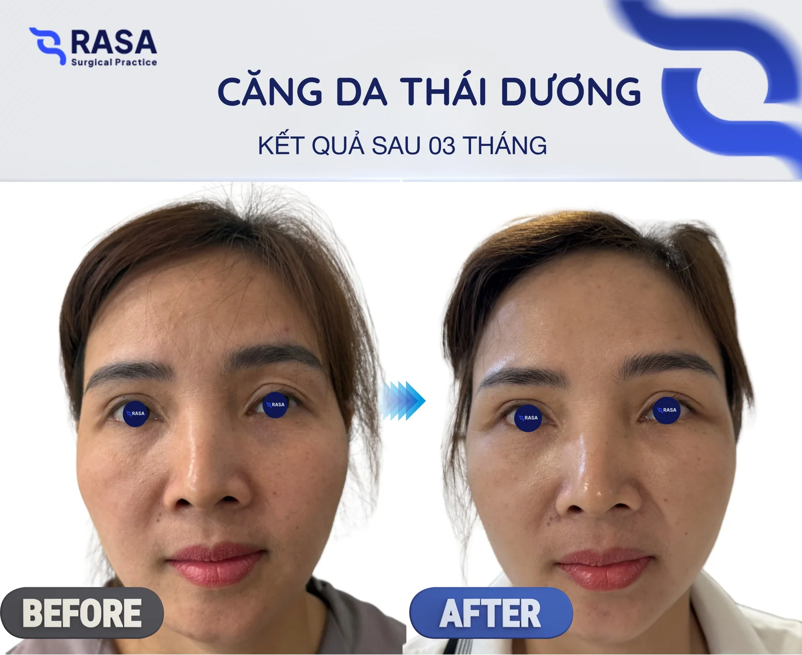 Temporal lift - After 3 months