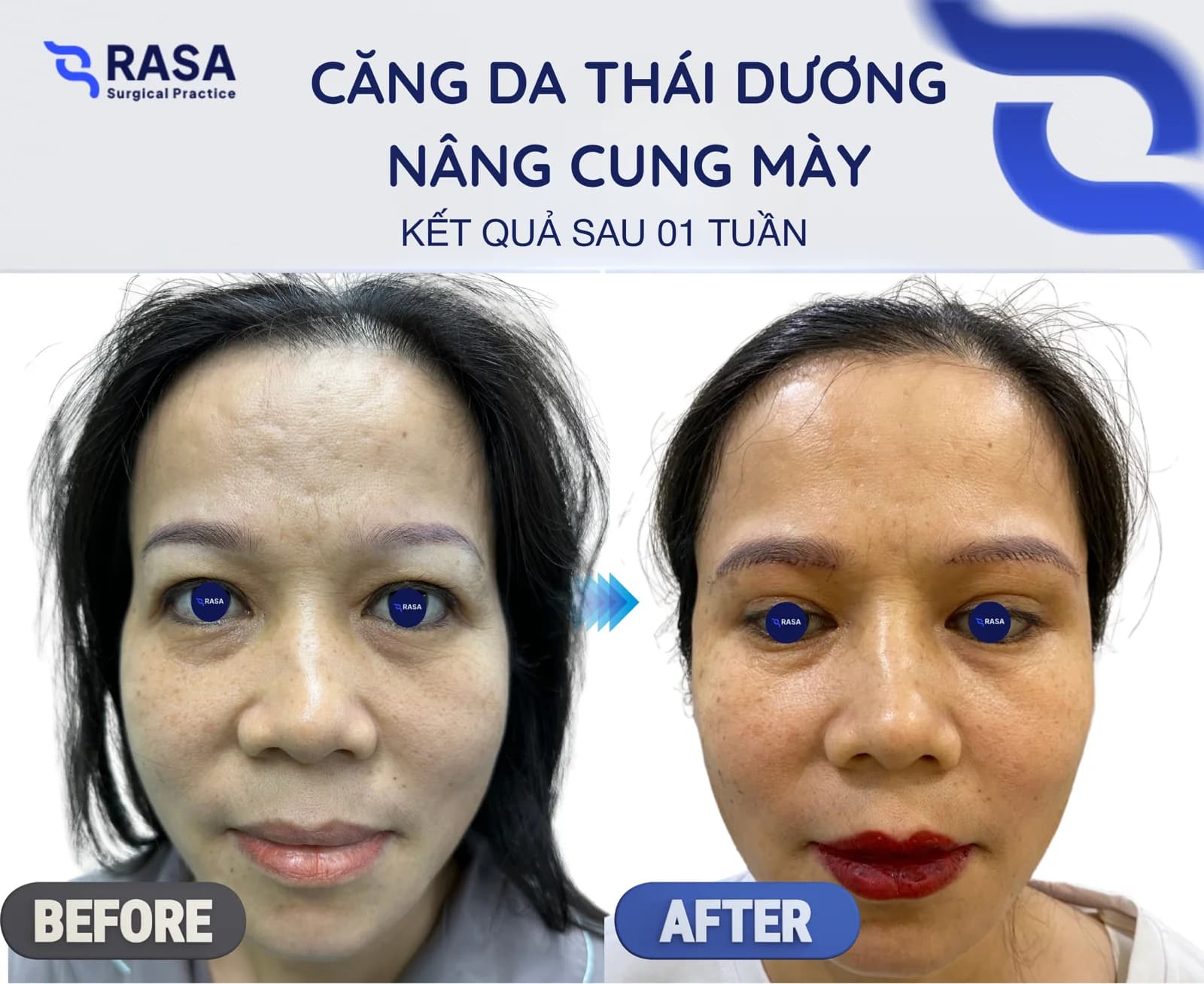 Temporal lift - brow lift - After 1 week
