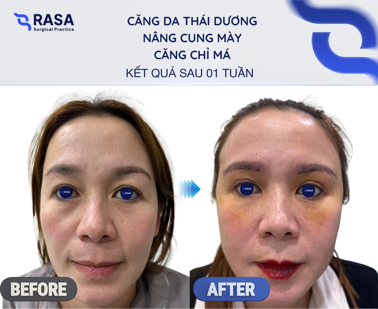 Temporal lift - brow lift - cheek thread lift - After 1 week