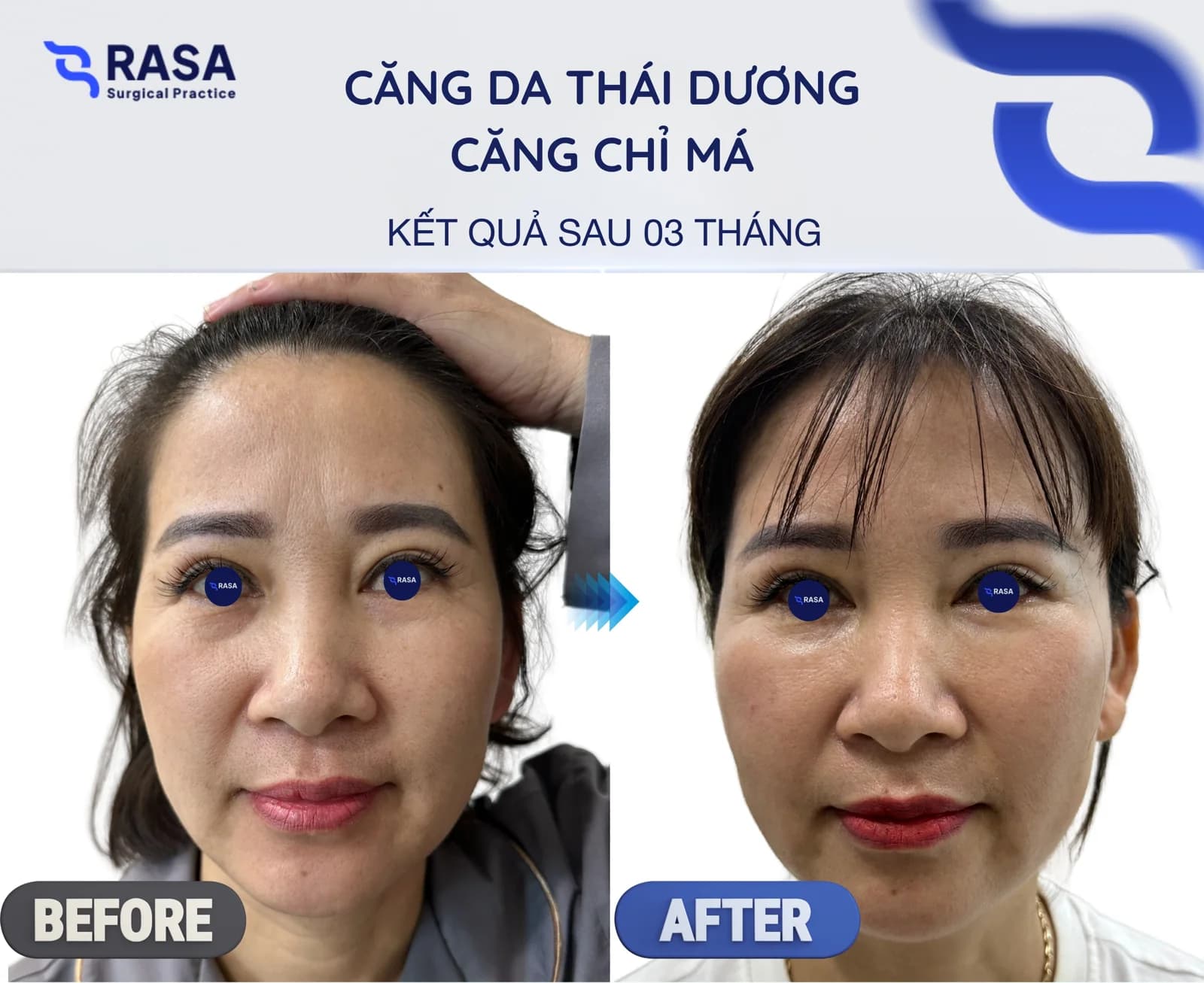 Temporal lift - cheek thread lift - After 3 months