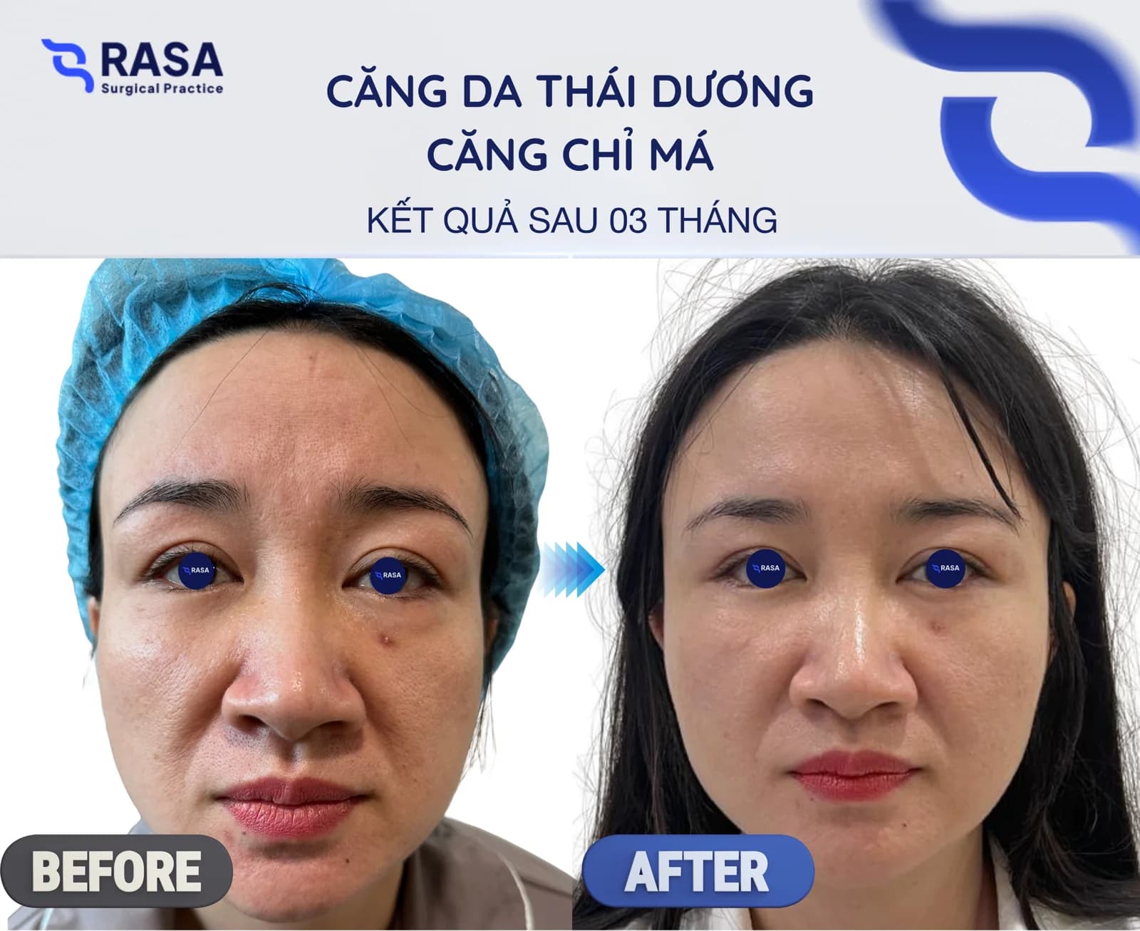 Temporal lift - cheek thread lift - After 3 months
