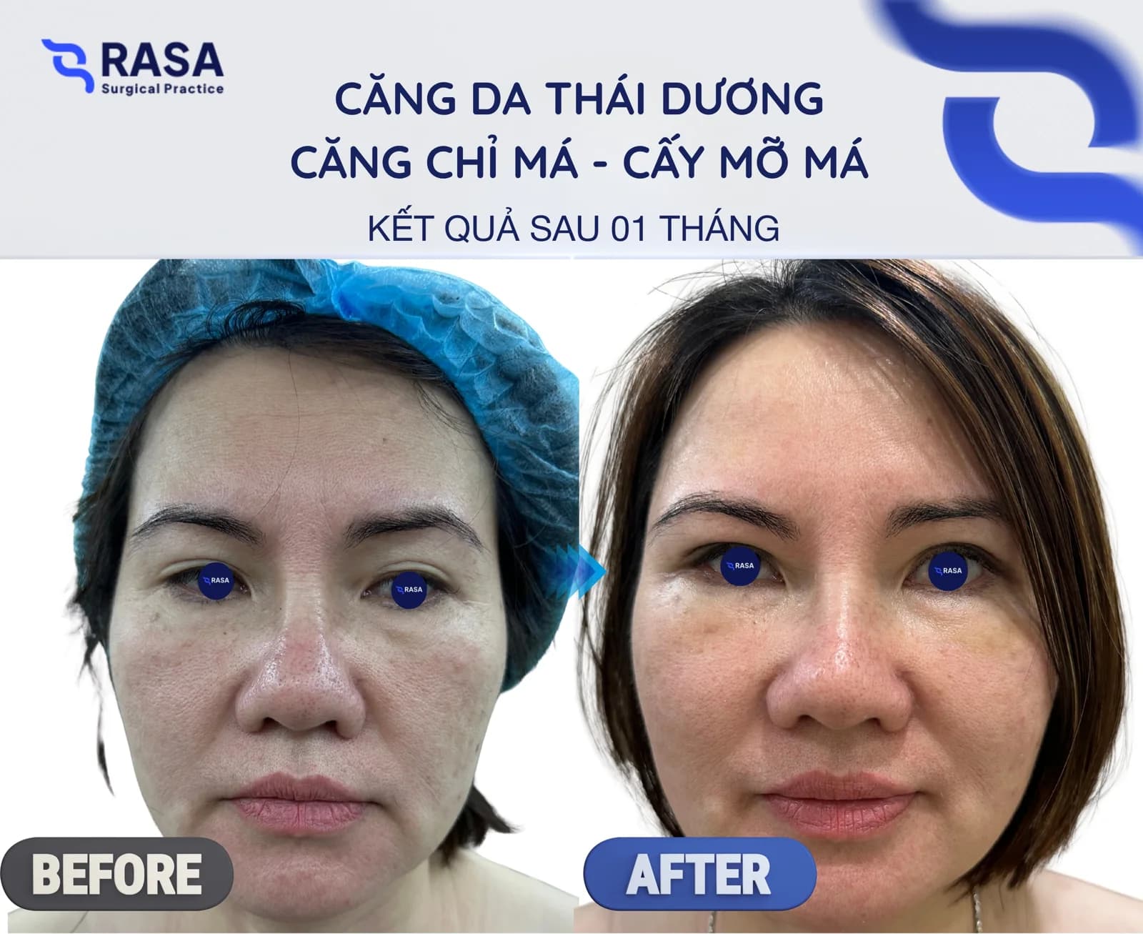 Temporal lift - cheek thread lift - cheek fat grafting - After 1 month