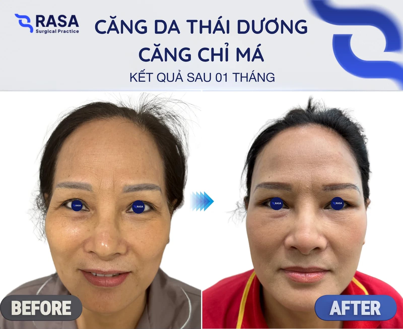 Căng da thái dương - căng chỉ má - Sau 1 tháng