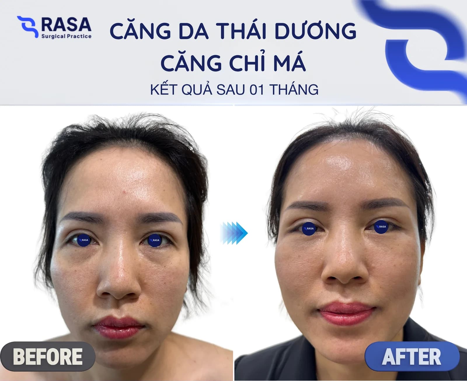 Căng da thái dương - căng chỉ má - Sau 1 tháng