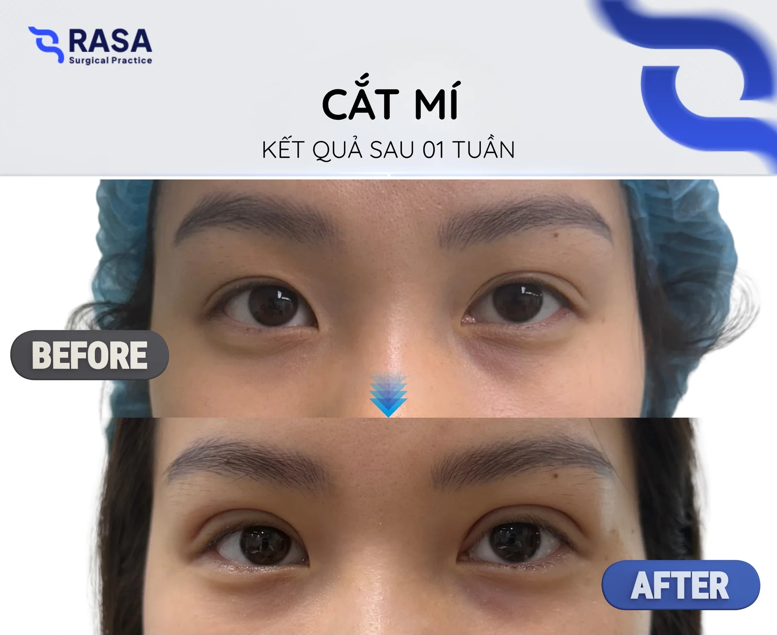 Cắt mí - Sau 1 tuần