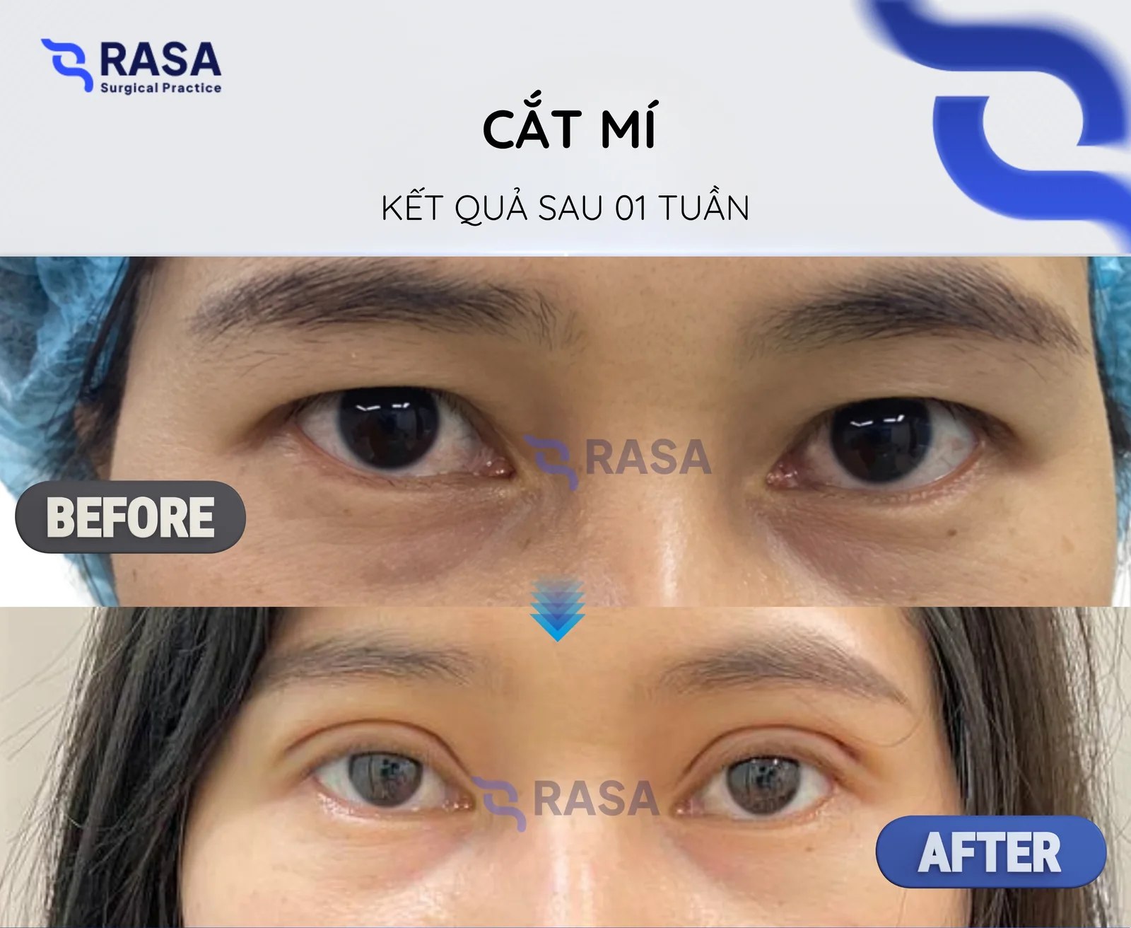 Cắt mí - Sau 1 tuần