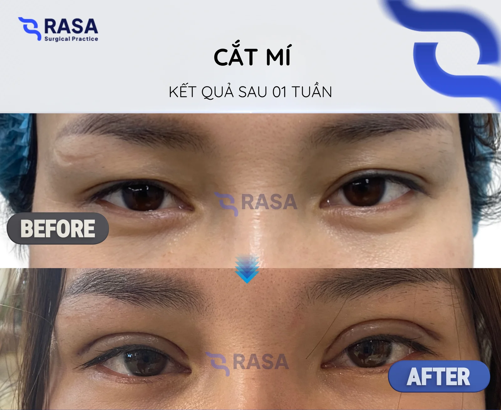 Cắt mí - Sau 1 tuần