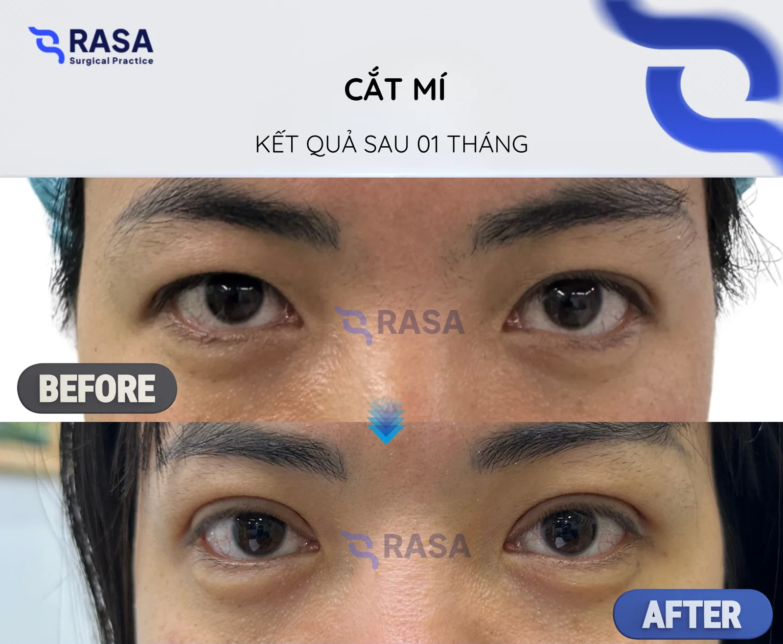 Blepharoplasty - After 1 month
