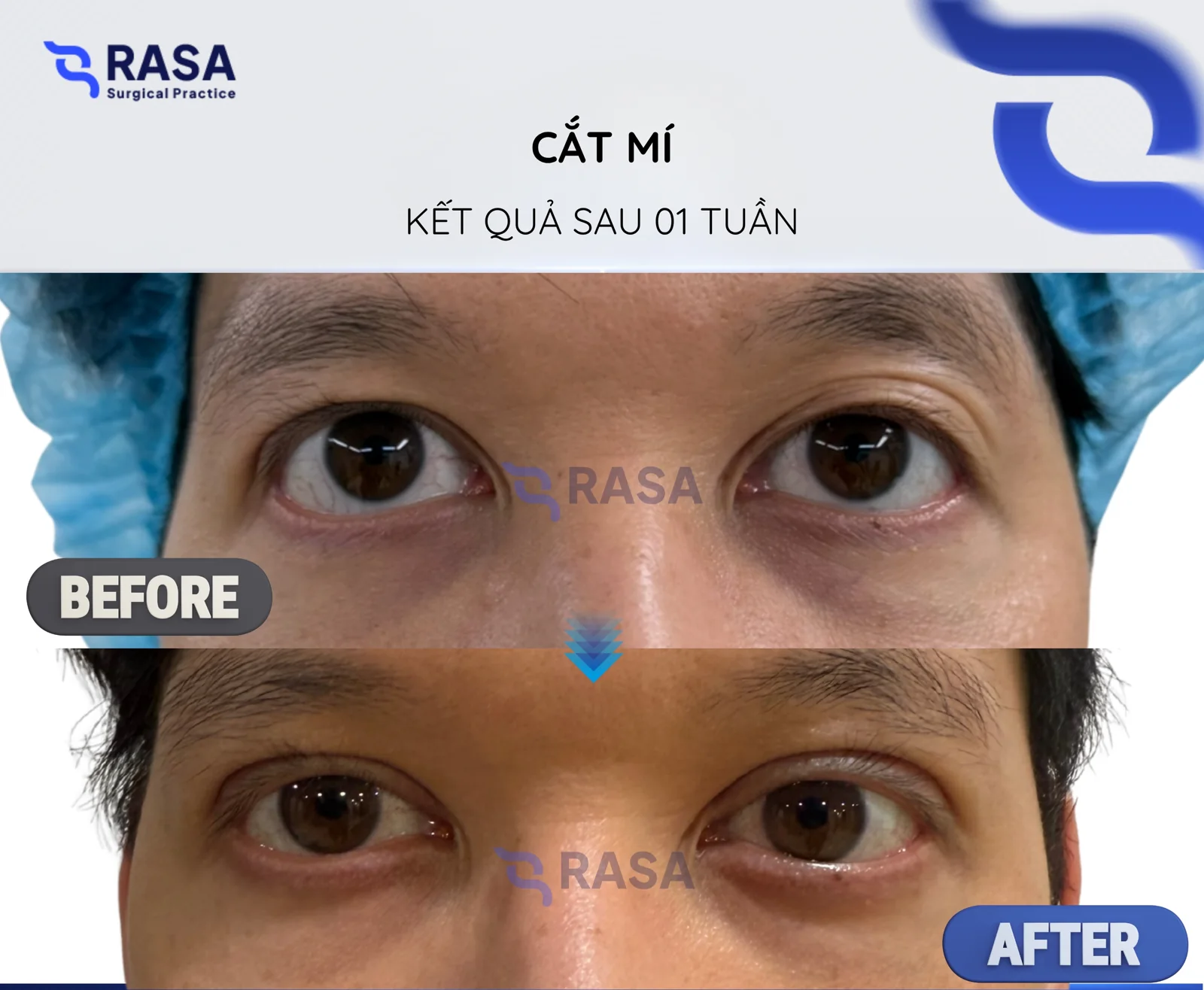 Blepharoplasty - After 1 week
