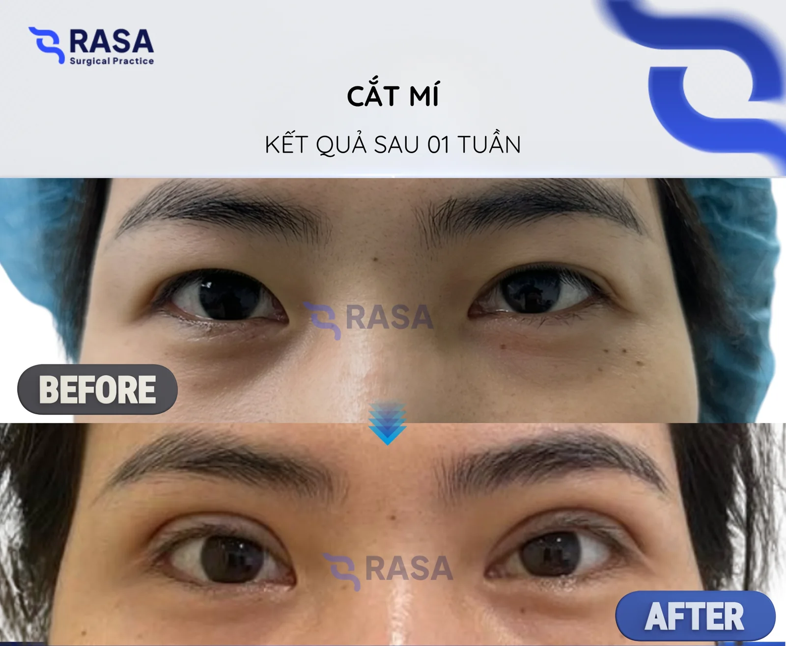Blepharoplasty - After 1 week
