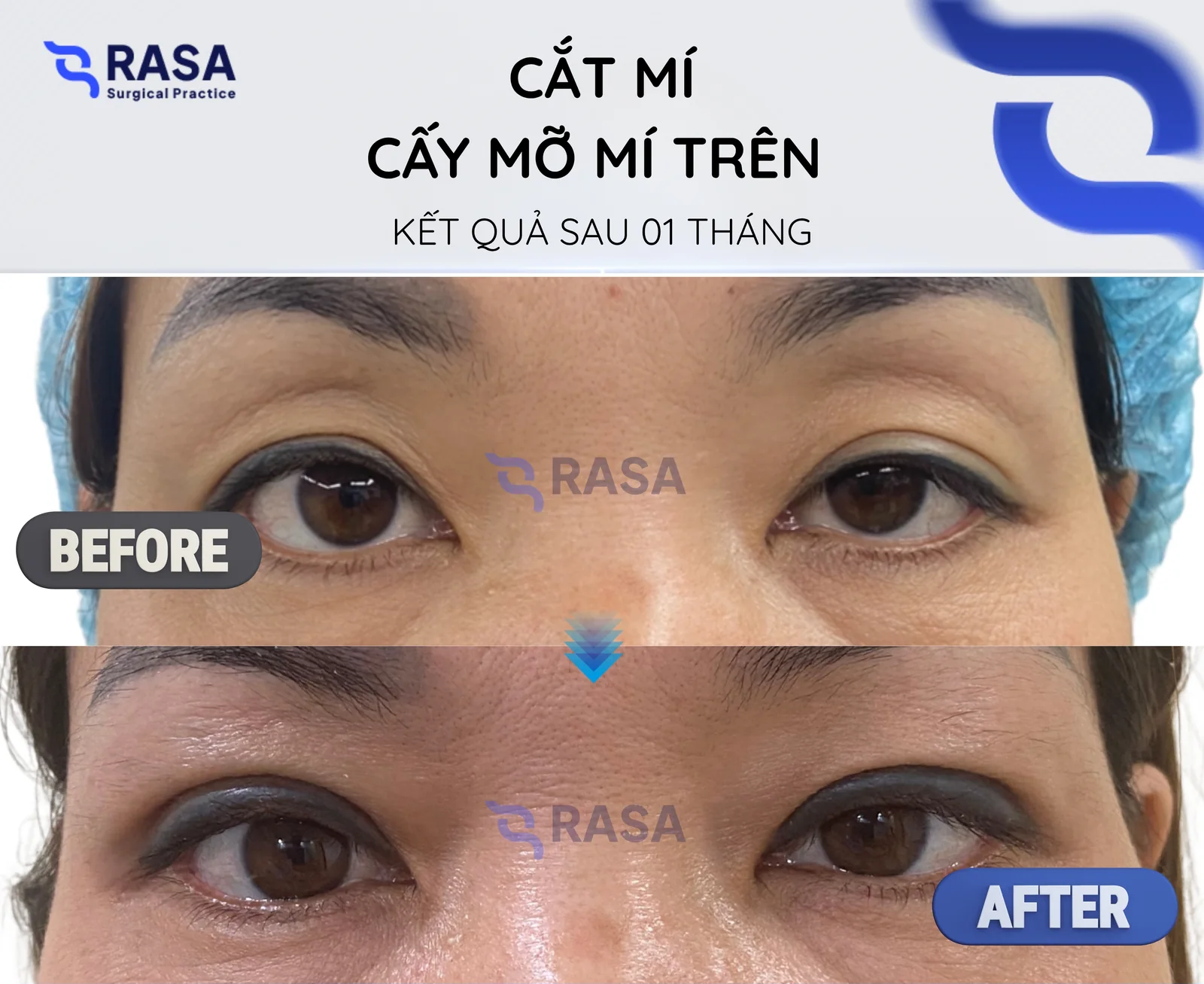 Cắt mí + cấy mỡ mí trên - Sau 1 tháng