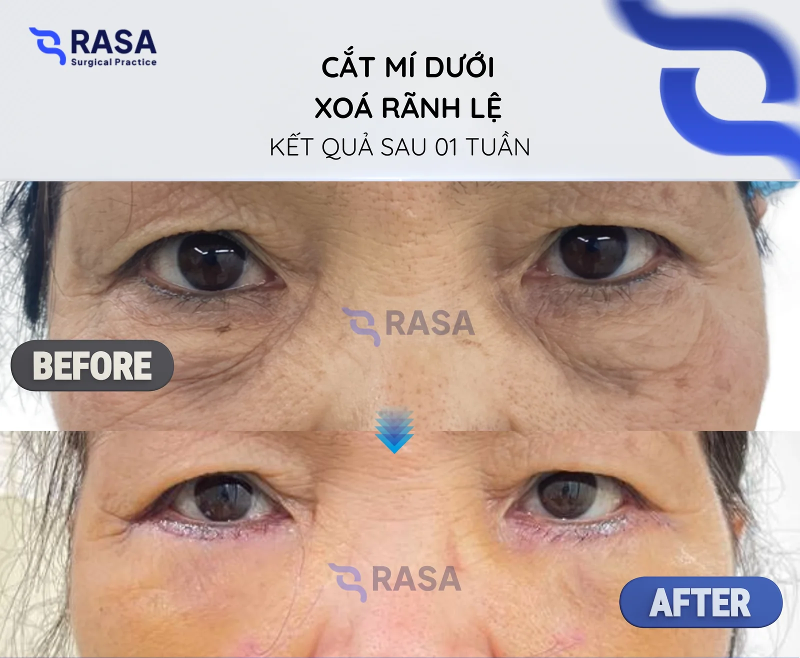 Cắt mí dưới - xoá rãnh lệ - Sau 1 tuần