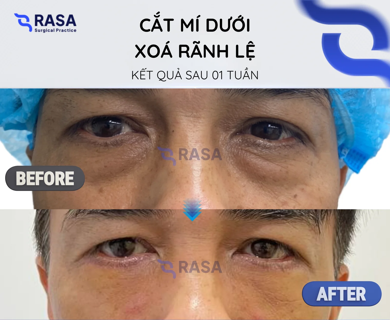Cắt mí dưới - xoá rãnh lệ - Sau 1 tuần