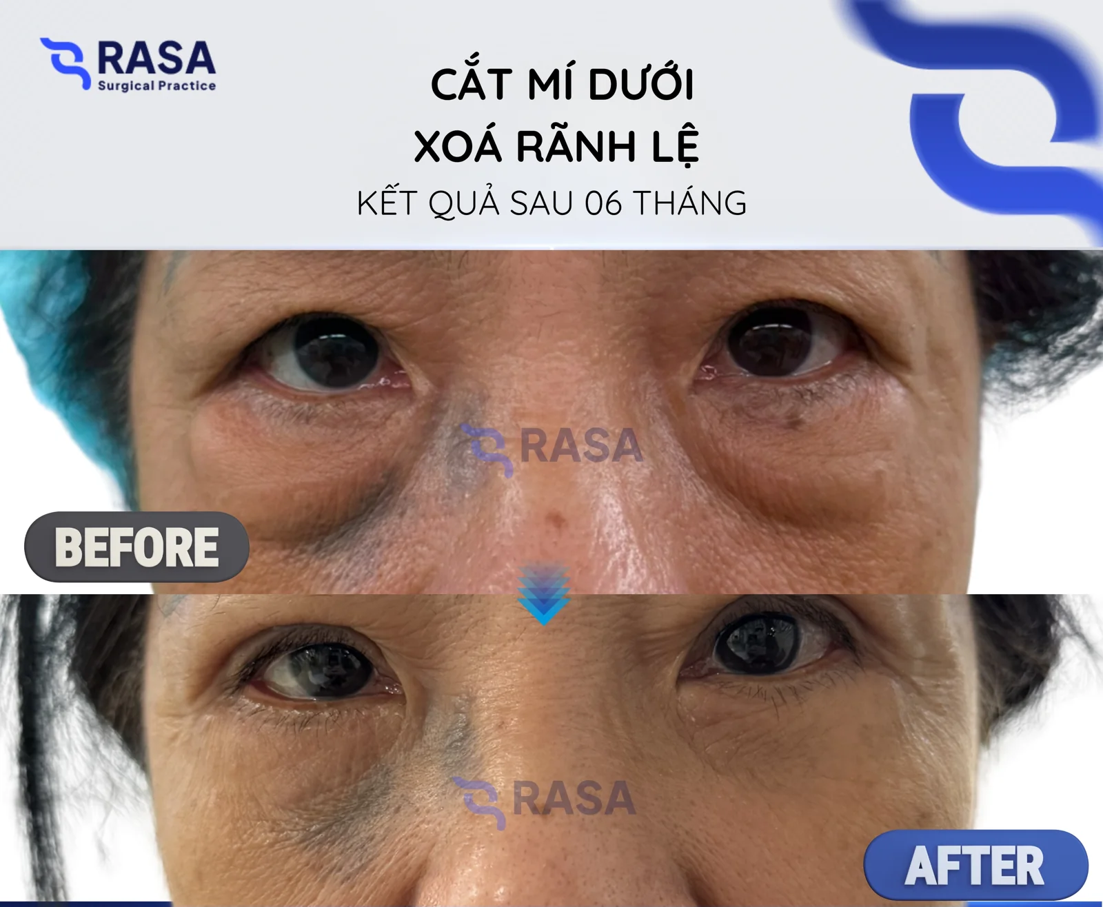 Lower blepharoplasty - tear-trough correction - After 6 months