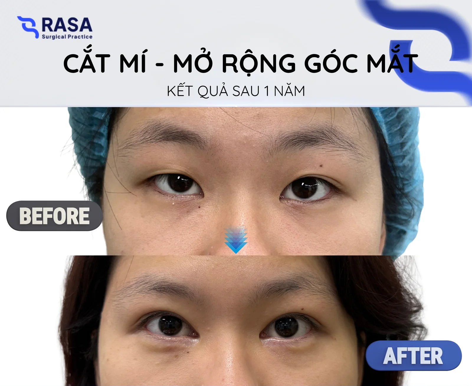 Cắt mí - mở rộng góc mắt - Sau 1 năm
