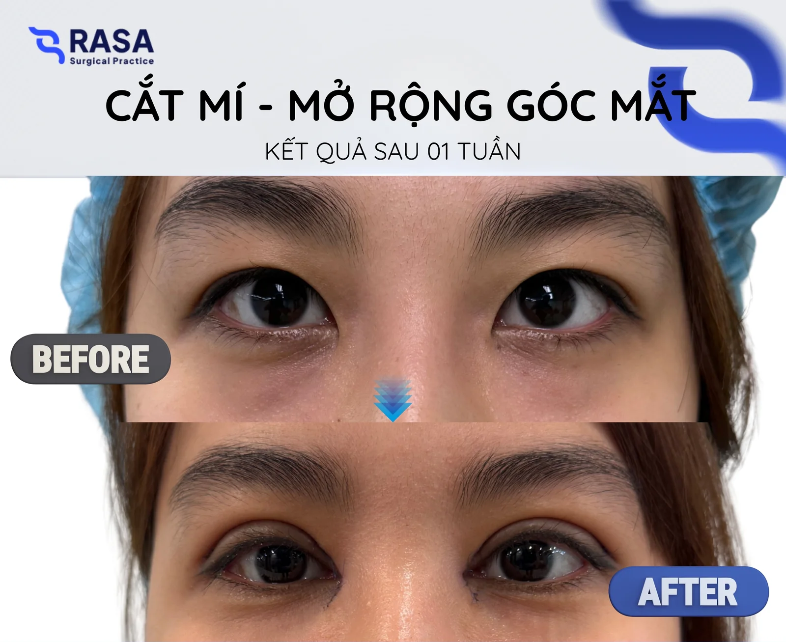 Cắt mí - mở rộng góc mắt - Sau 1 tuần
