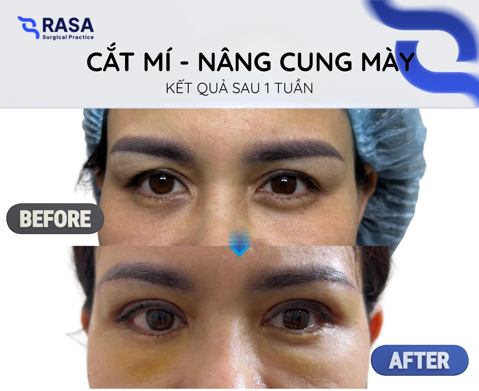 Cắt mí - nâng cung mày - Sau 1 tuần