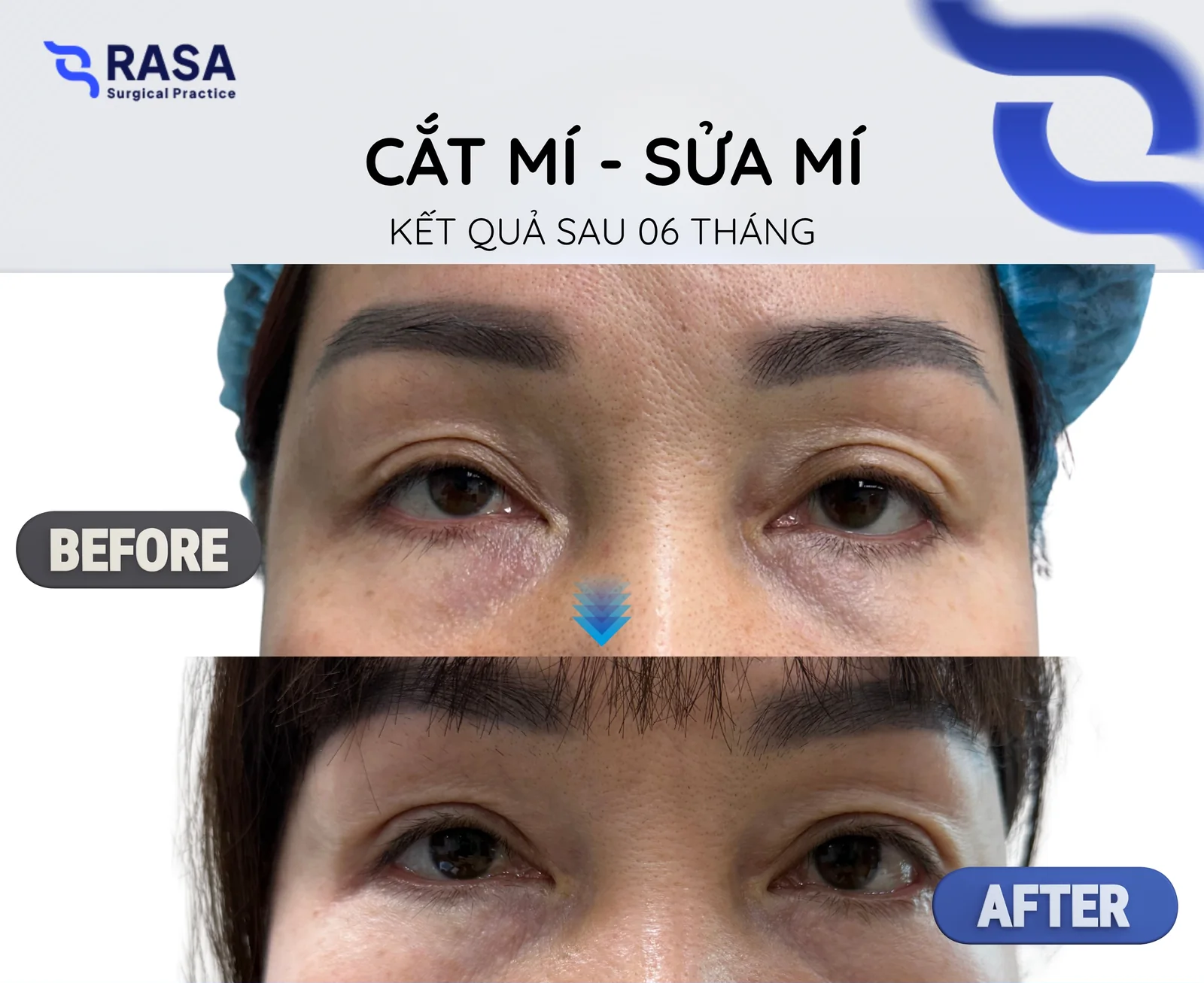 Cắt mí - sửa mí - Sau 6 tháng