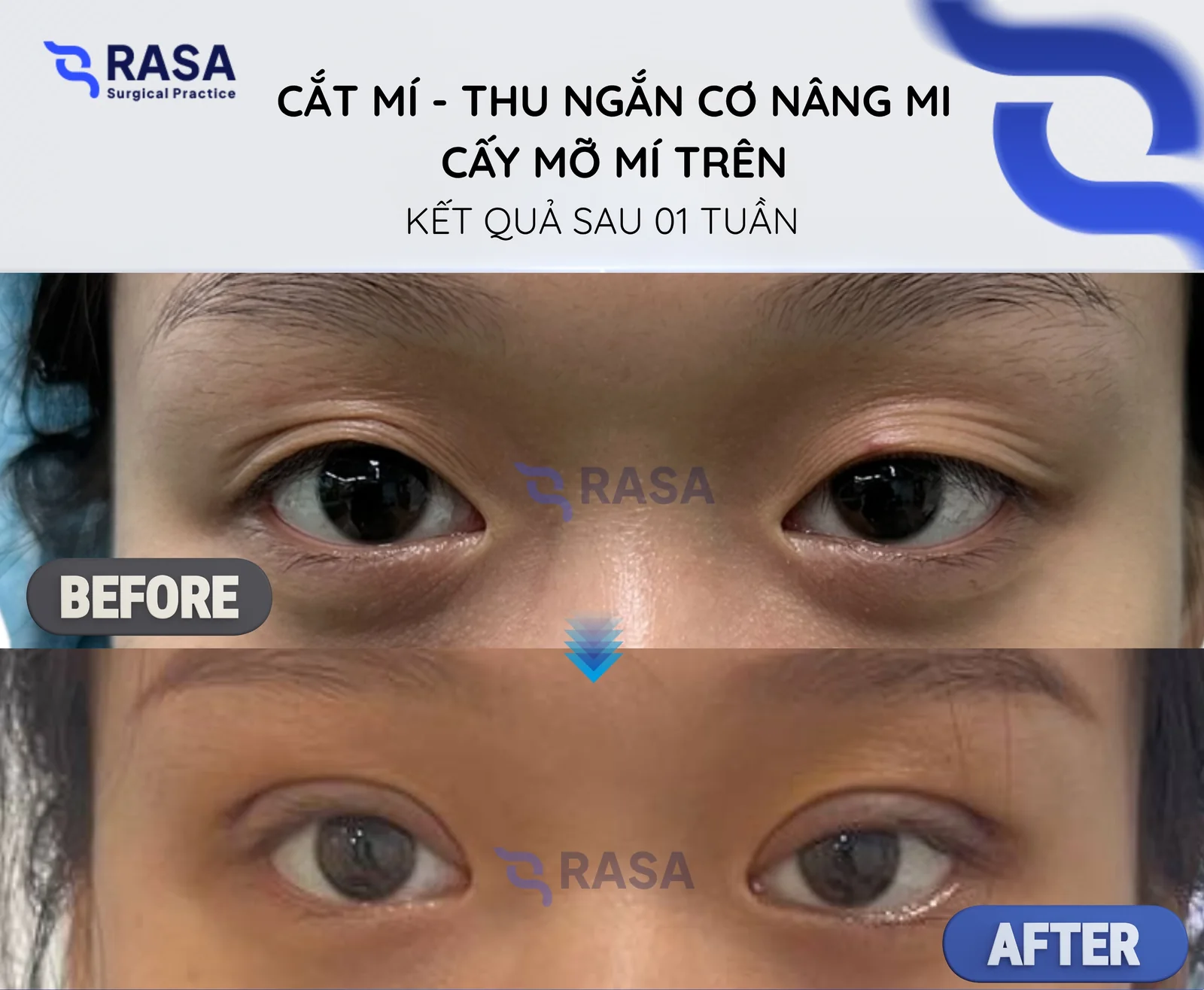 Cắt mí - thu ngắn cơ nâng mi + cấy mỡ mí trên - Sau 1 tuần