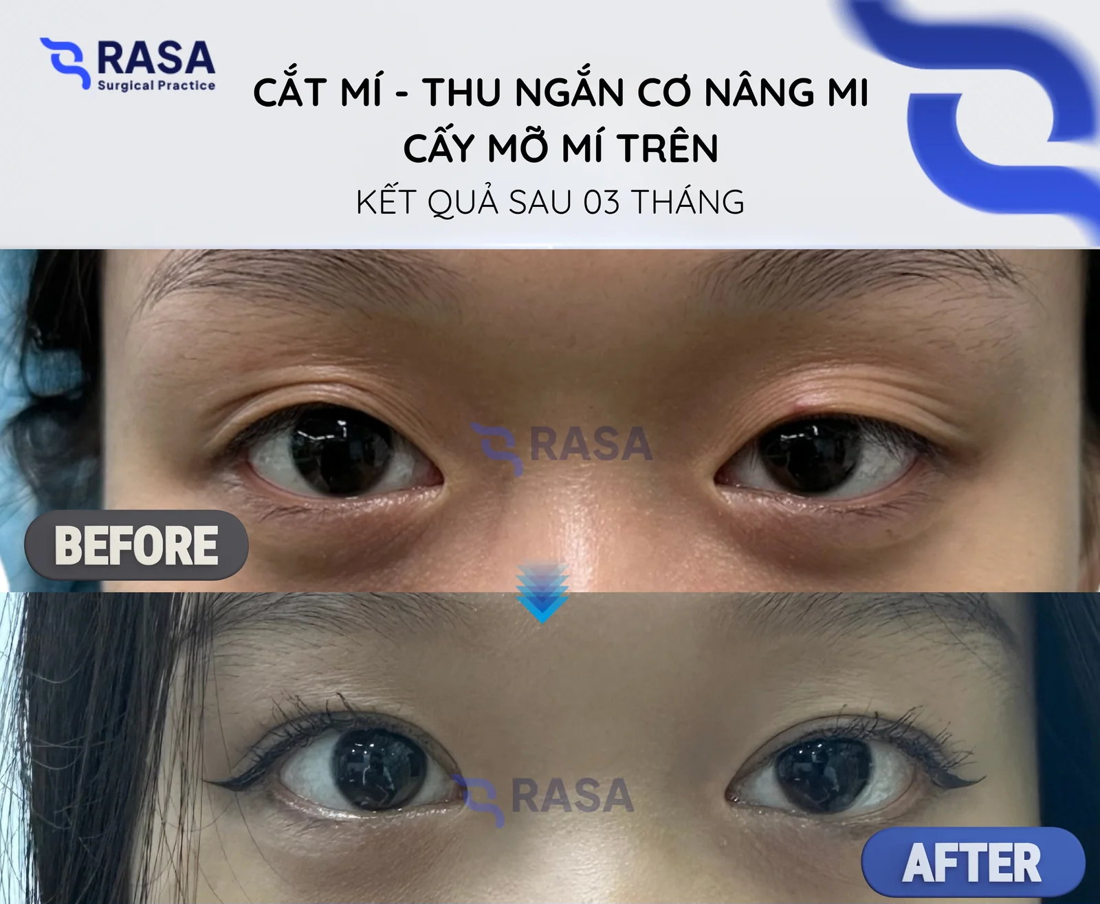Cắt mí - thu ngắn cơ nâng mi + cấy mỡ mí trên - Sau 3 tháng