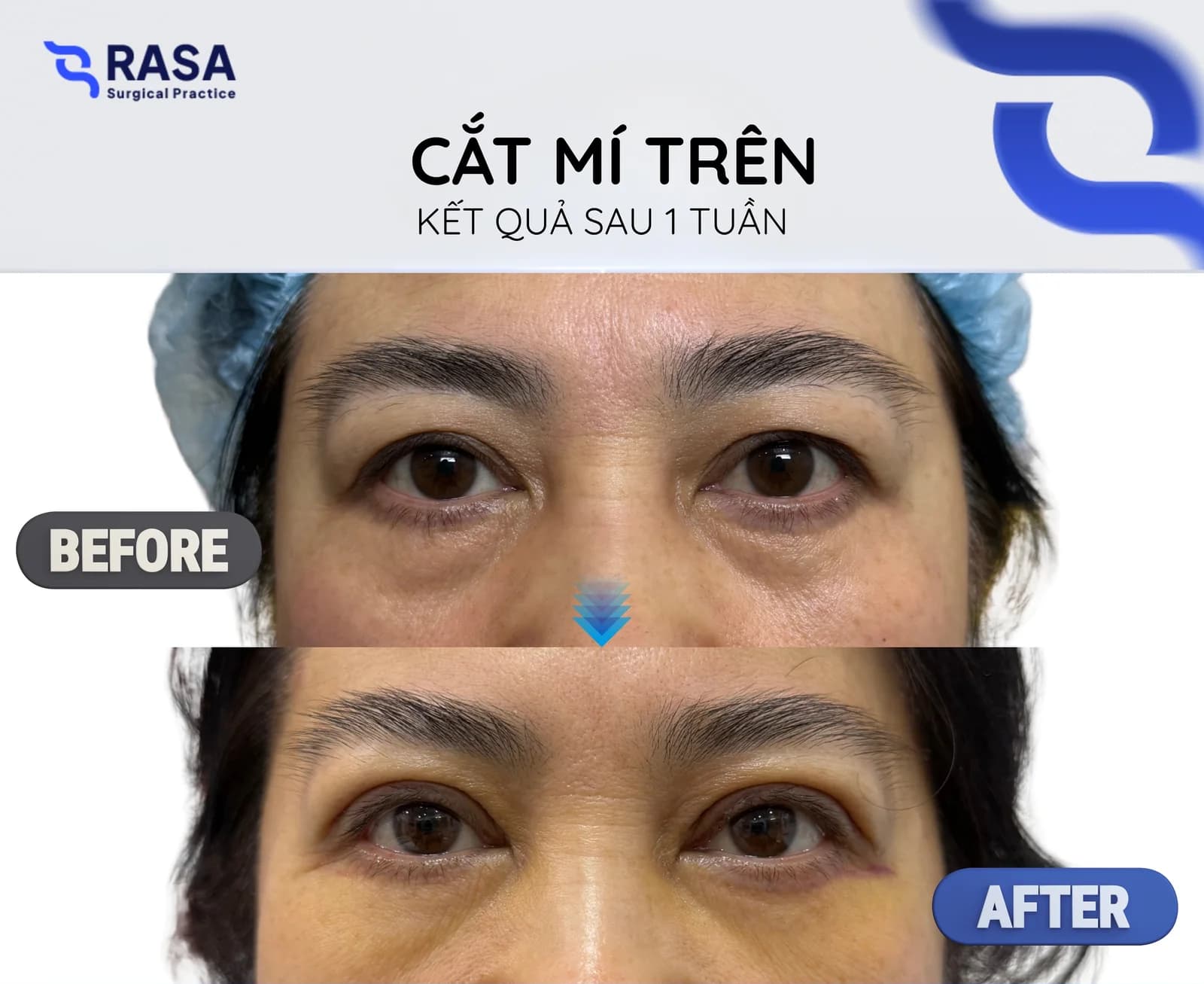 Cắt mí trên - Sau 1 tuần