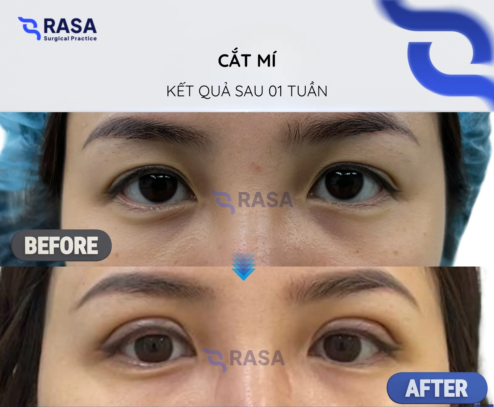 Upper blepharoplasty - After 1 week