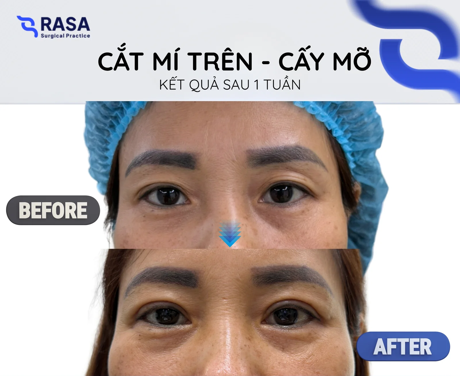 Cắt mí trên - cấy mỡ - Sau 1 tuần