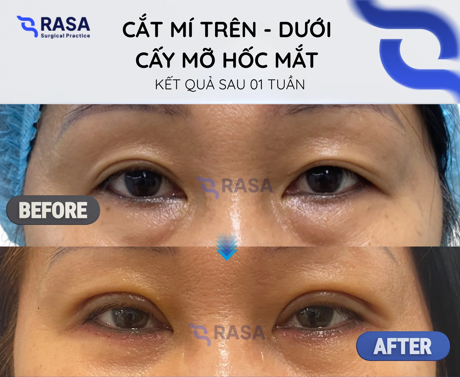 Cắt mí trên - dưới + cấy mỡ hốc mắt - Sau 1 tuần