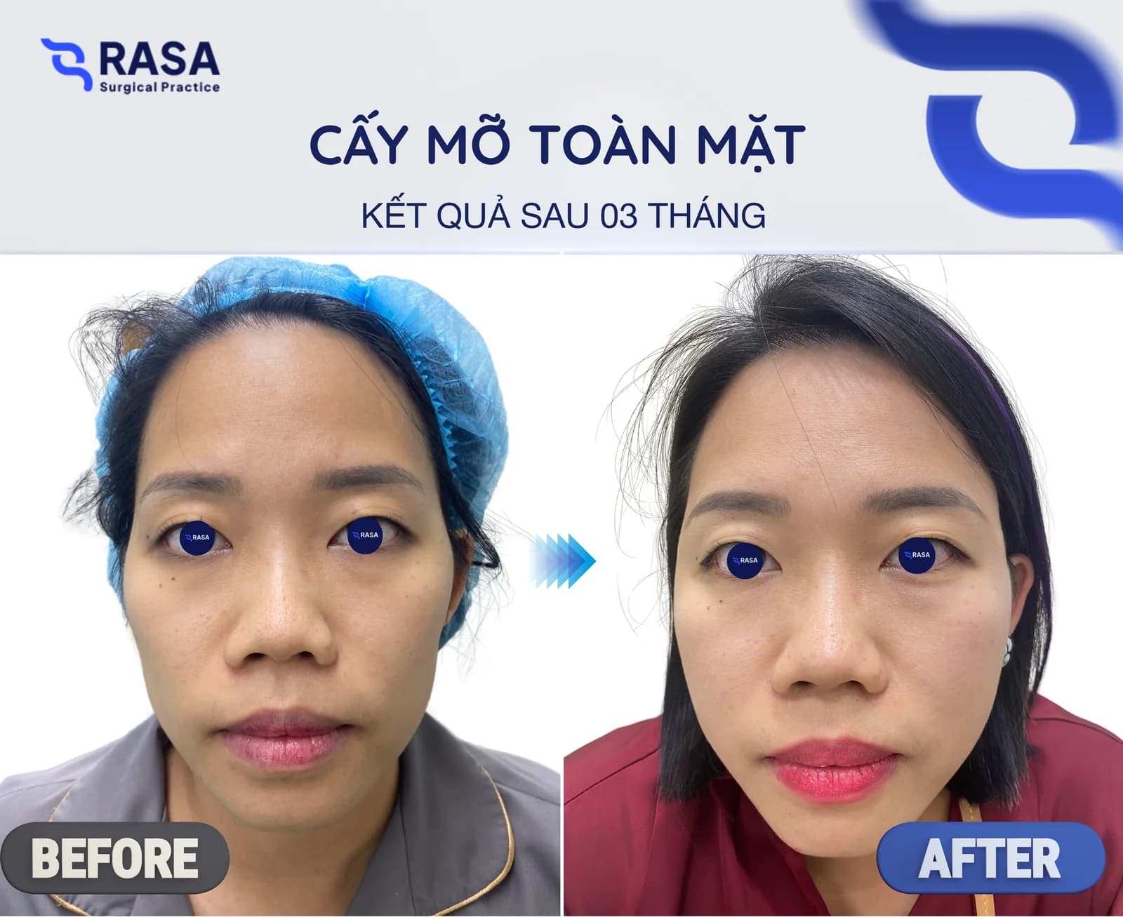 Cấy mỡ toàn mặt - Sau 3 tháng