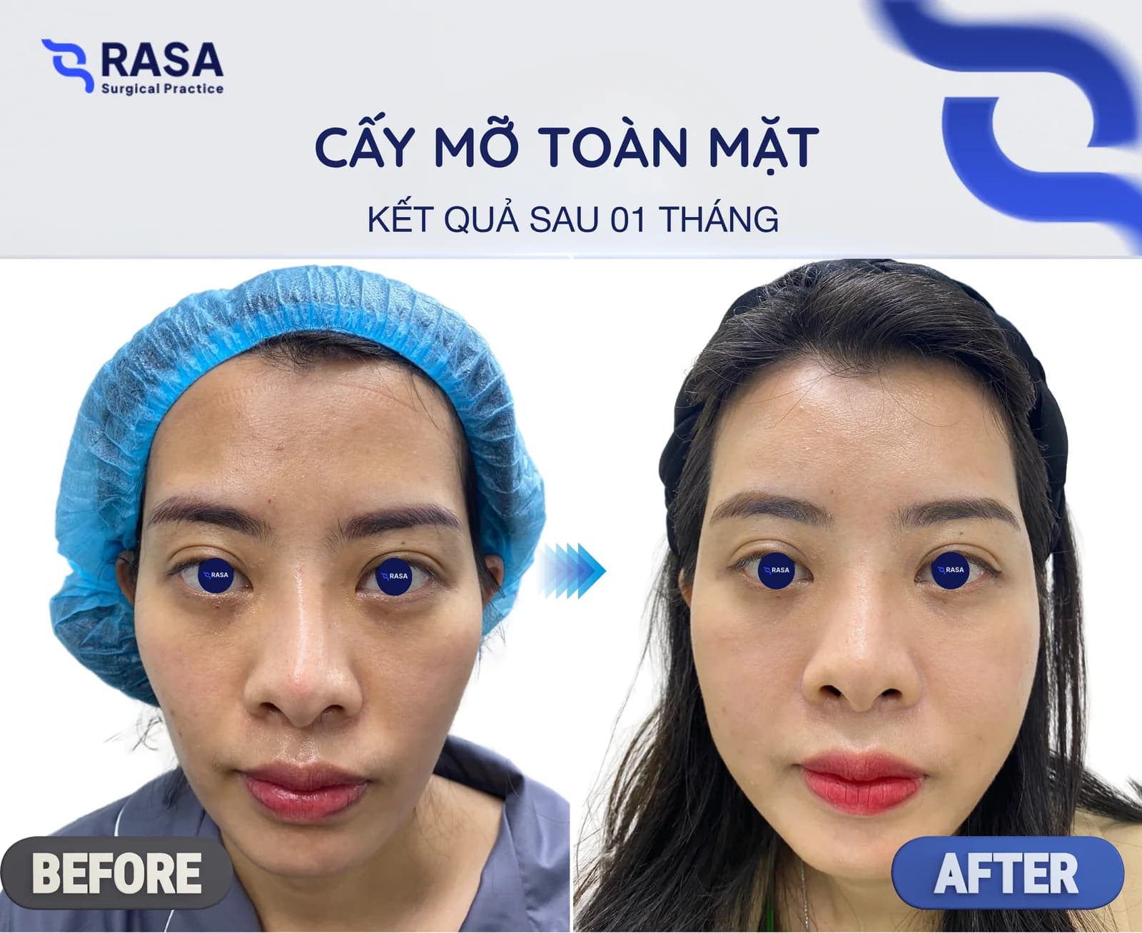 Cấy mỡ toàn mặt - Sau 1 tháng