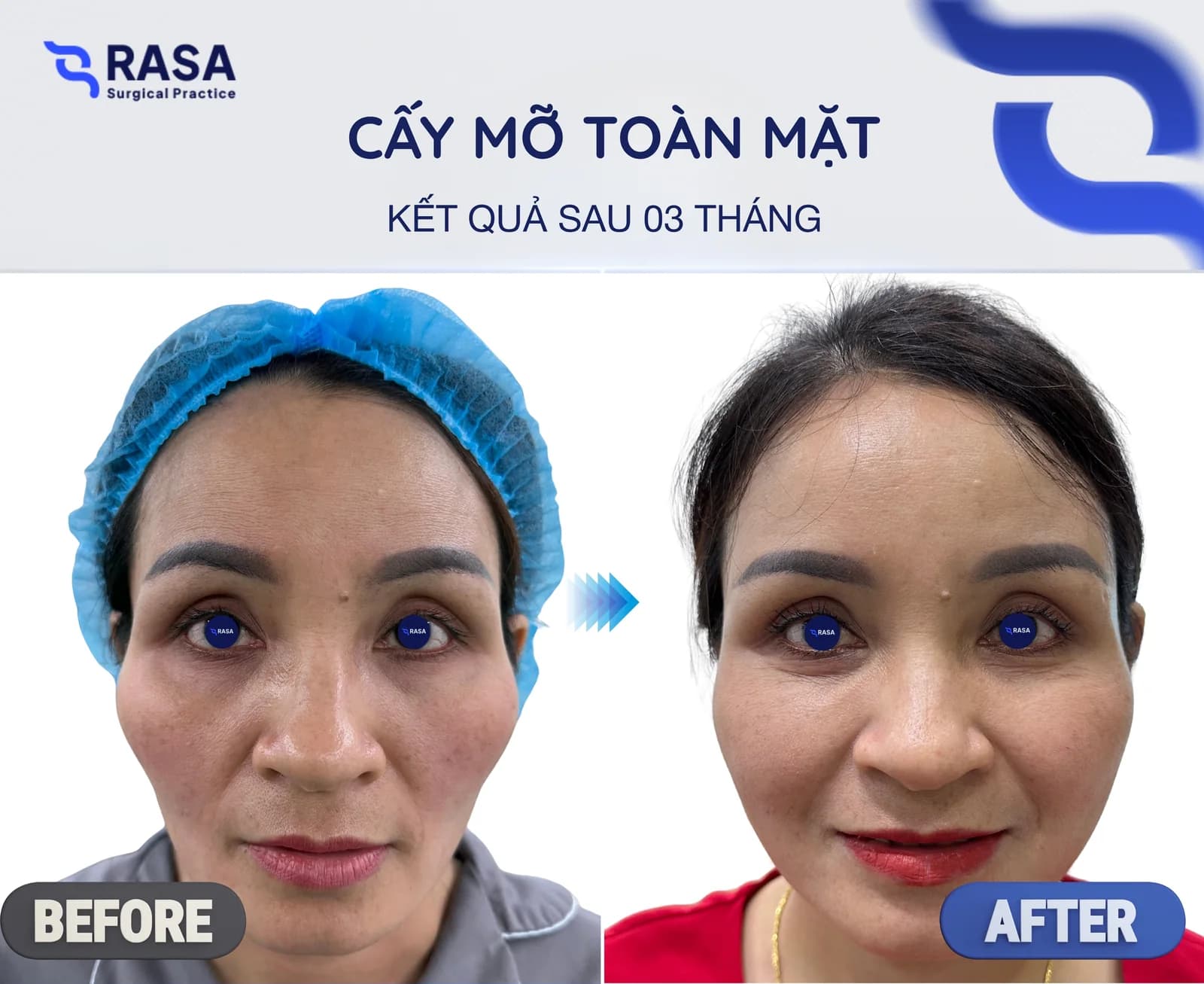 Cấy mỡ toàn mặt - Sau 3 tháng