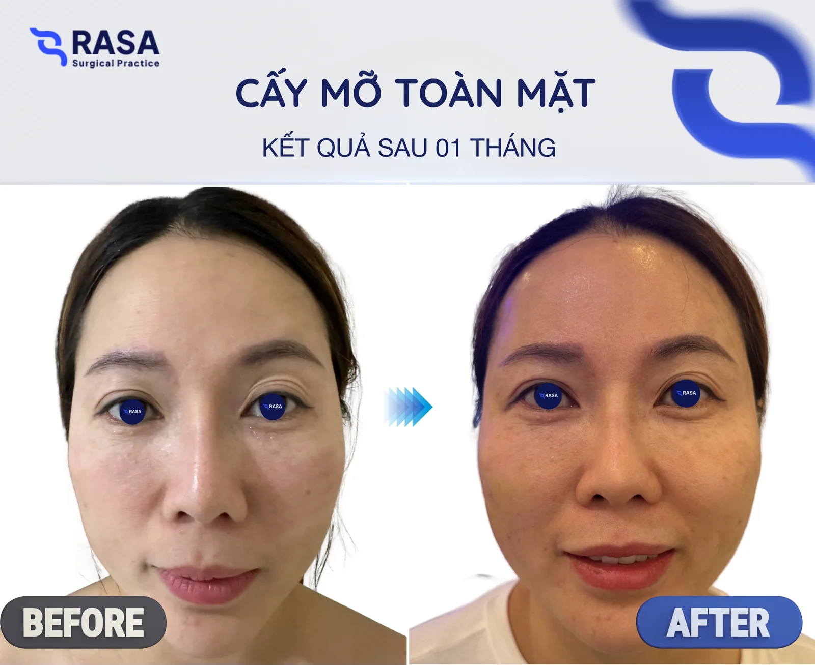 Cấy mỡ toàn mặt - Sau 1 tháng