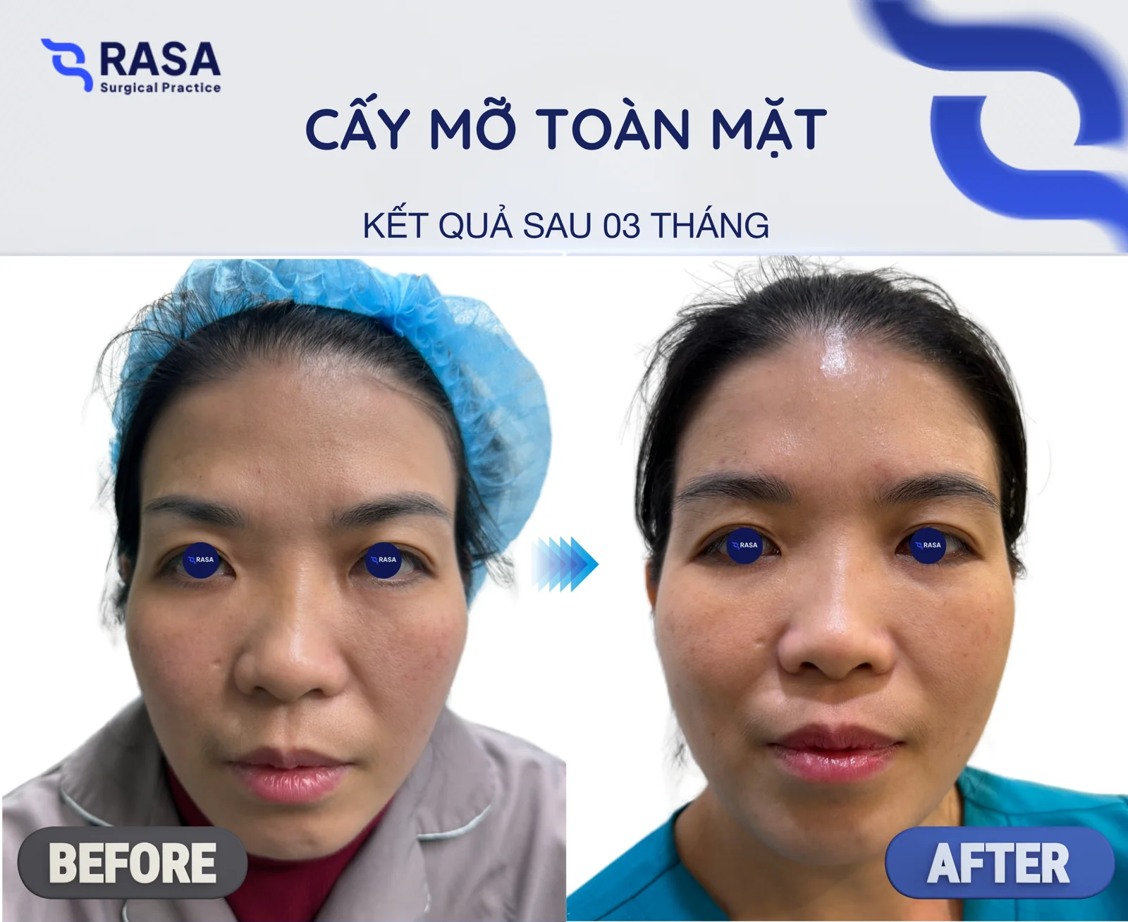 Full-face fat grafting - After 3 months