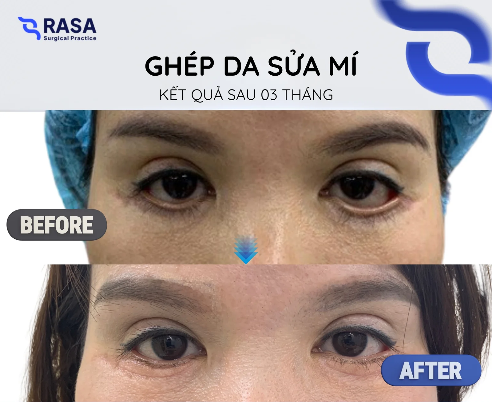 Ghép da sửa mí dưới - Sau 3 tháng