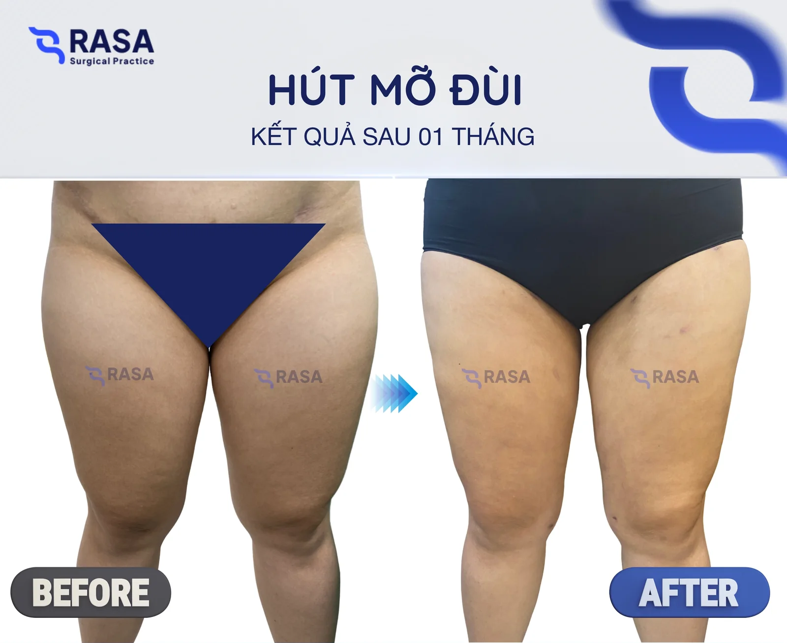 Hút mỡ đùi - Sau 1 tháng