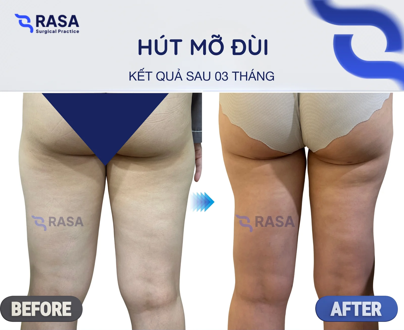 Hút mỡ đùi - Sau 3 tháng