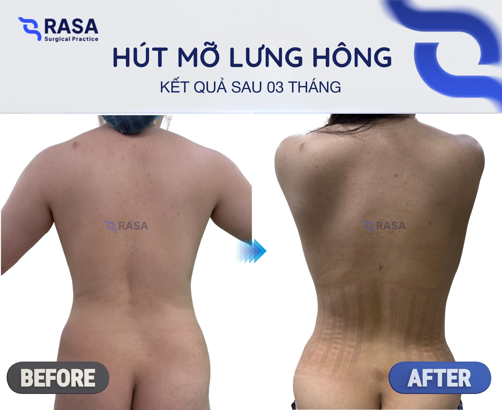 Hút mỡ lưng hông - Sau 3 tháng
